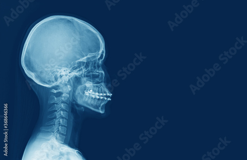 x-ray of human cervical spine and head skull