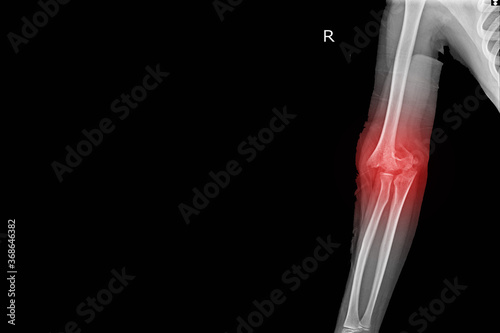 X-ray Elbow joint Finding Supracondylar fracture distal humerus with joint effusion.Medical image concept.
