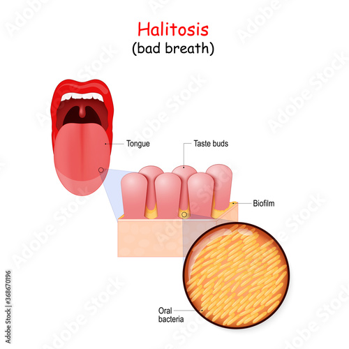 Bad breath and bacteria that cause halitosis. Human mouth