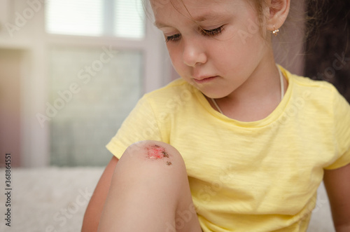 focus on broken baby knee. A little sad girl examines and processes her Scraped broken knees. Childhood injuries