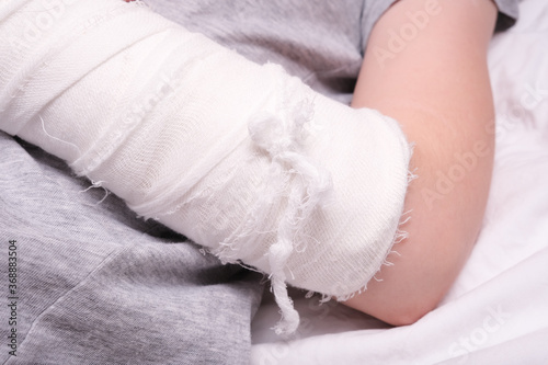 фотографія A child broken arm in plaster case, hand injury because of accident, forearm bon