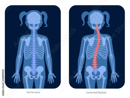 Spine X ray