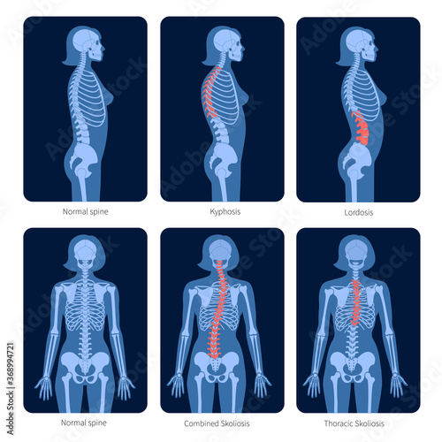 Spine X ray