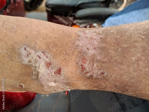 scabies feet dry because of not taking care of nutrition photo