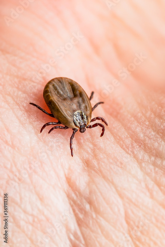 Encephalitis Infected Tick Insect Crawling on Skin. Lyme Borreliosis Disease or Encephalitis Virus Infectious Dermacentor Tick Arachnid Parasite Macro.