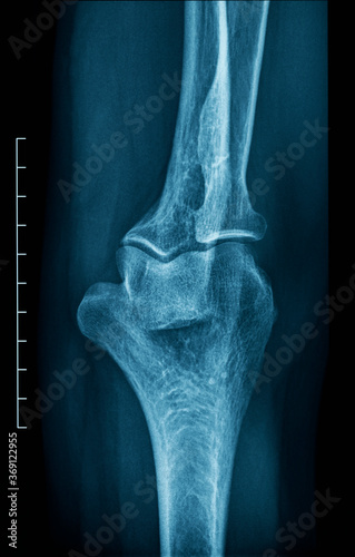 X-ray of an human elbow photo