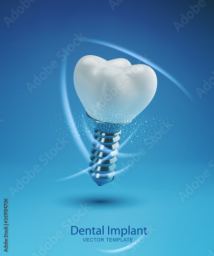 Vector template with realistic 3d prosthesis. Dental implant isolated on a blue background. Element for design.