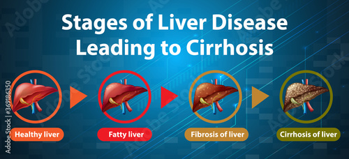 Stages of liver disease leading to Cirrhosis