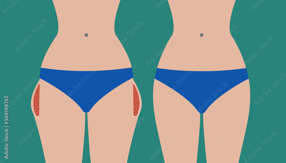 Hip liposuction, hip correction before and after