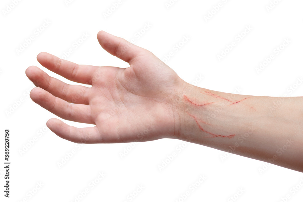 Child's hand scratched by cat on the wrist. Isolated on white background. Child's hand scratched by cat on the wrist. Isolated on white background.