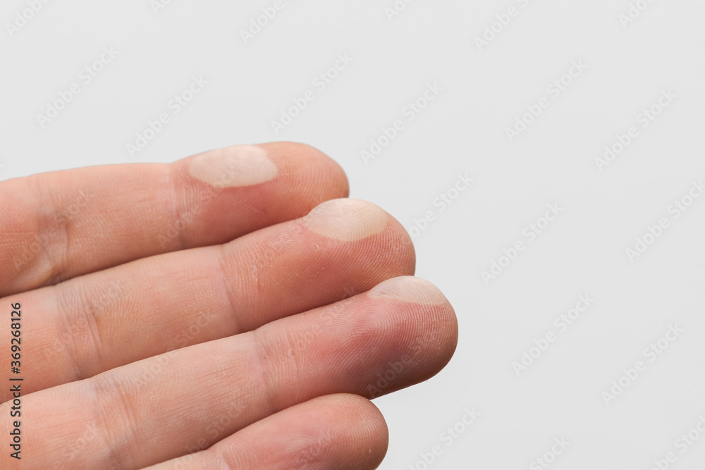 Human hand with painful blisters on three fingertips from touching hot