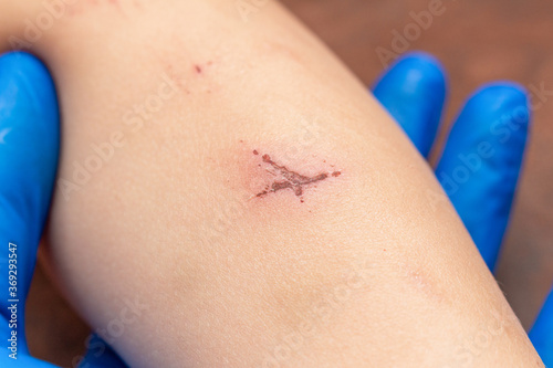 wounds, scratches, abrasions on the child’s leg, knee close up