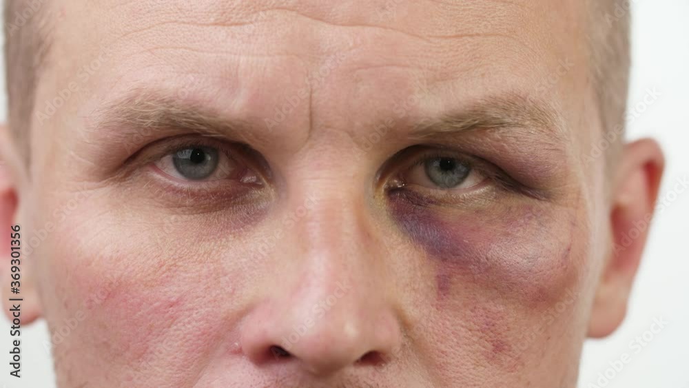 Bruise on the eye of a man Bruise on the eye of a man