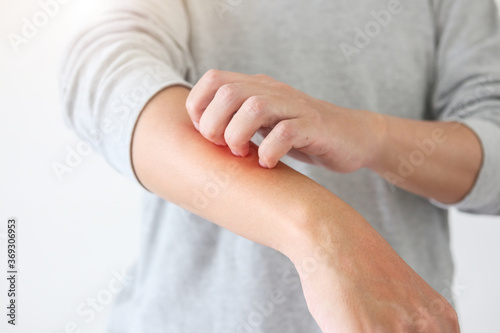 Young asian man itching and scratching on arm from itchy dry skin eczema dermatitis photo