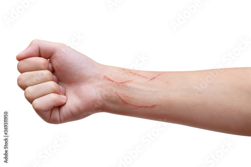 Child's hand scratched by cat on the wrist. Palm clenched. Isolated on white background.