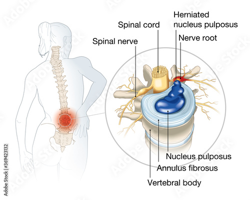 Lumbal vertebra with intervertebral disc and herniated nucleus pulposus photo