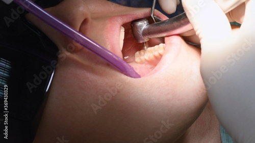 Drilling teeth and sucking saliva with ejector. Young woman at dental clinic. Female dentist with assistant treating cavities in a patient mouth in modern dental office.