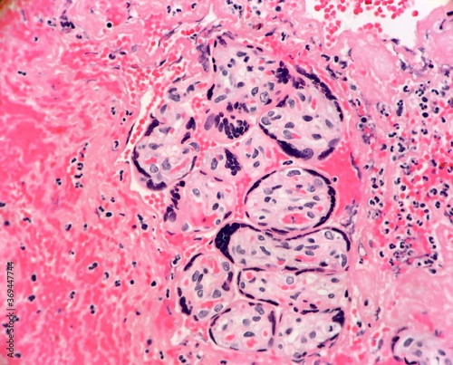 Slightly degenerated early trimester chorionic villi surrounded by blood, fibrin and Inflammation. Microscopic view. photo