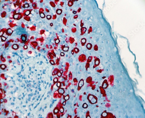Foto Carcinoma of the nipple skin called Paget's Disease
