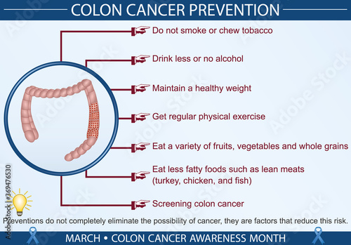 Colon cancer prevention infographic vector. March colon cancer awareness month concept. Well-organized Eps 10 file.