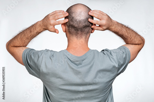 A man holds his hands over his bald head, demonstrating focal alopecia. Rear view. The concept of baldness and male alopecia
