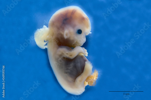 Human embryo with occipital encephalocele. photo