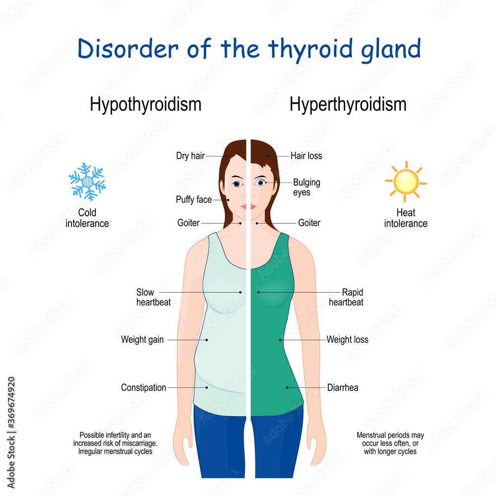 Hyperthyroidism and Hypothyroidism. Female with Signs and symptoms of different thyroid gland diseases - obrazy, fototapety, plakaty 
