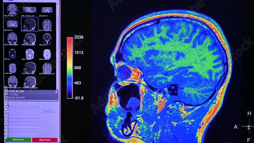 Close up video of a MRI (Magnetic Resonance Imaging) or CAT scanner screen showing the examination in progress