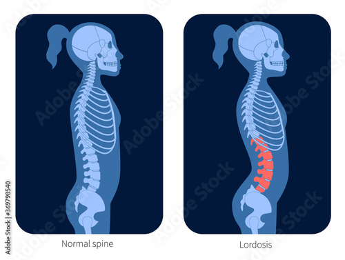 Spine X ray