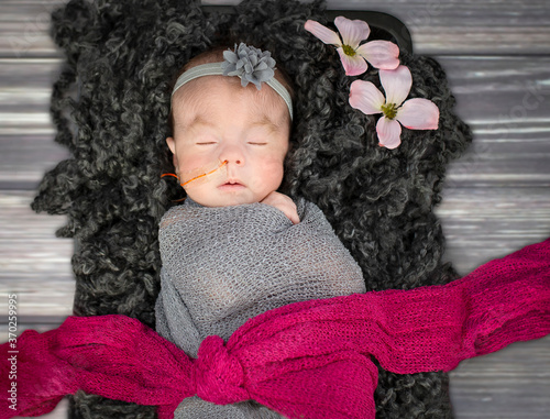 Sweet sleeping baby girl with Trisomy 18 and a nasogastric tube for enteral feeding photo