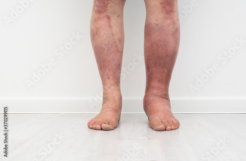 Close up photo of legs with lymphostasis front view photo
