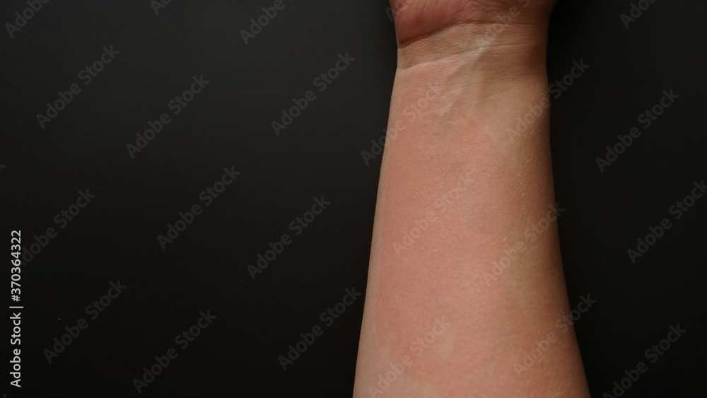 Female hand covered with red spots, close-up. Allergic reaction to an antibiotic. Hand on the black background Female hand covered with red spots, close-up. Allergic reaction to an antibiotic. Hand on the black background