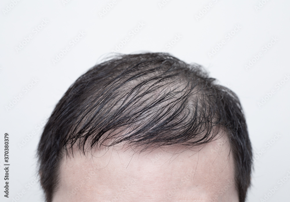 Close up man's head with hair loss, thinning hair or alopecia isolated on white background. Hair problem. Close up man's head with hair loss, thinning hair or alopecia isolated on white background. Hair problem.
