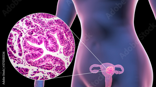 Uterine cancer, illustration and micrograph photo