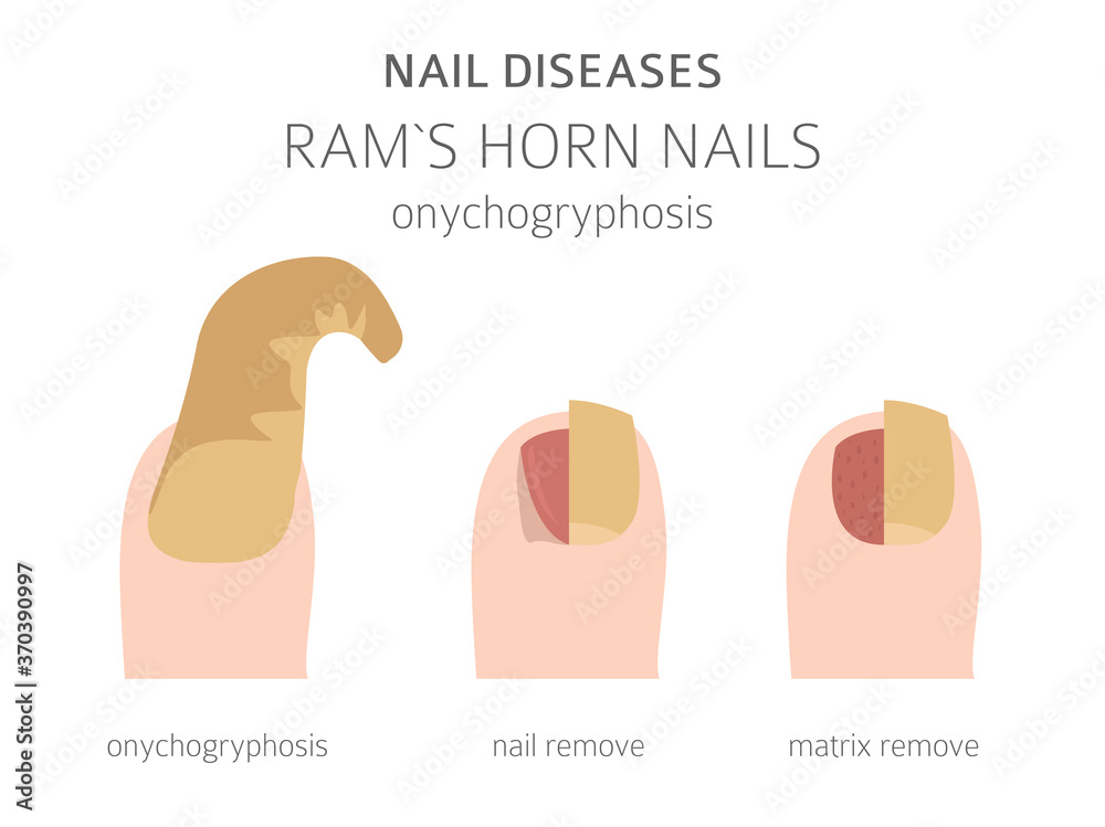 Nail diseases. Onychogryphosis, Ram`s horn nail. Medical infographic design  Stock Vector | Adobe Stock