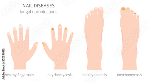 Nail diseases. Onychomycosis, nail fungal infection causes, treatment icon set. Medical infographic design