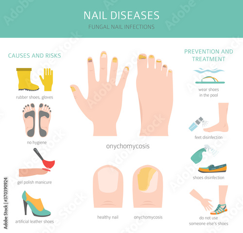 Nail diseases. Onychomycosis, nail fungal infection causes, treatment icon set. Medical infographic design