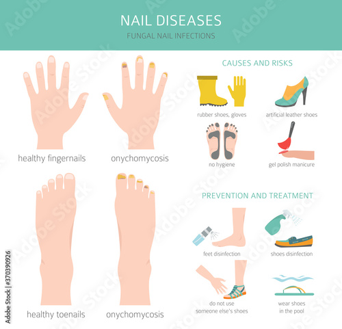 Nail diseases. Onychomycosis, nail fungal infection causes, treatment icon set. Medical infographic design