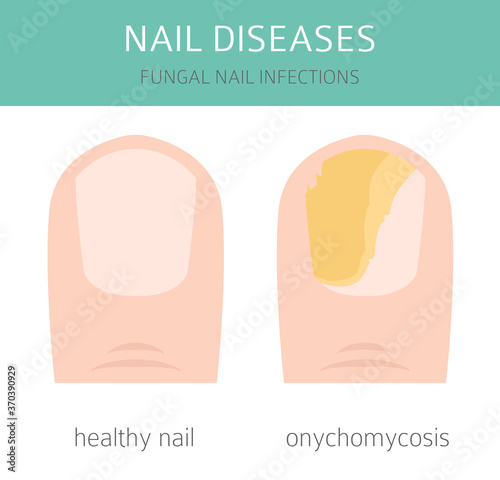 Nail diseases. Onychomycosis, nail fungal infection causes, treatment icon set. Medical infographic design