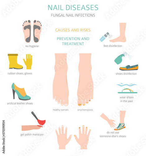 Nail diseases. Onychomycosis, nail fungal infection causes, treatment icon set. Medical infographic design