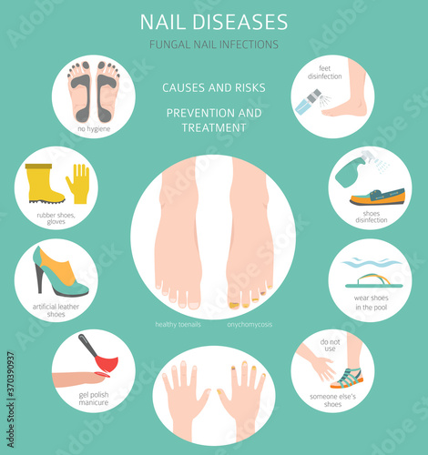 Nail diseases. Onychomycosis, nail fungal infection causes, treatment icon set. Medical infographic design