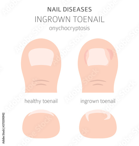 Nail diseases. Onychocryptocosis, ingrown toenail. Medical infographic design