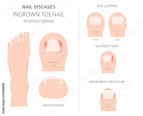 Nail diseases. Onychocryptocosis, ingrown toenail. Medical infographic design