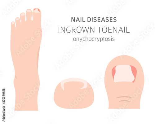 Nail diseases. Onychocryptocosis, ingrown toenail. Medical infographic design