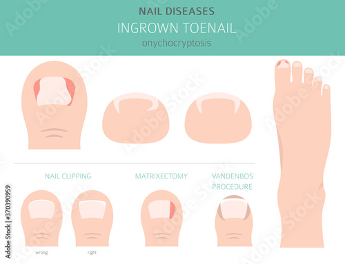 Nail diseases. Onychocryptocosis, ingrown toenail. Medical infographic design photo