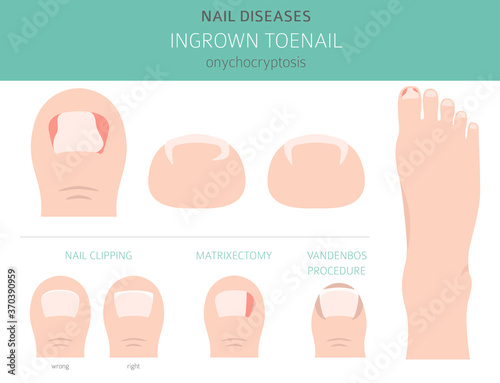 Nail diseases. Onychocryptocosis, ingrown toenail. Medical infographic design