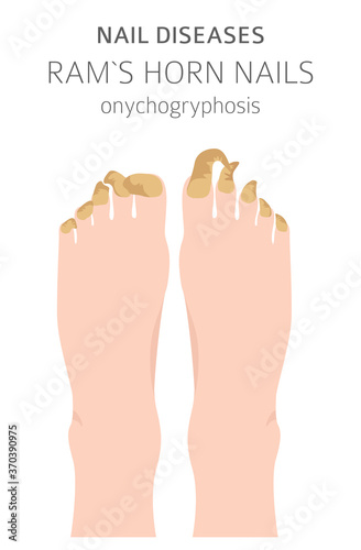 Nail diseases. Onychogryphosis, Ram`s horn nail. Medical infographic design