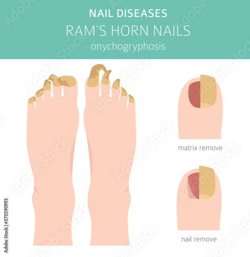 Nail diseases. Onychogryphosis, Ram`s horn nail. Medical infographic design