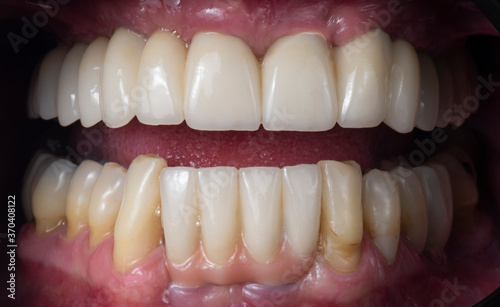 all on six dental ceramic restoration on implants