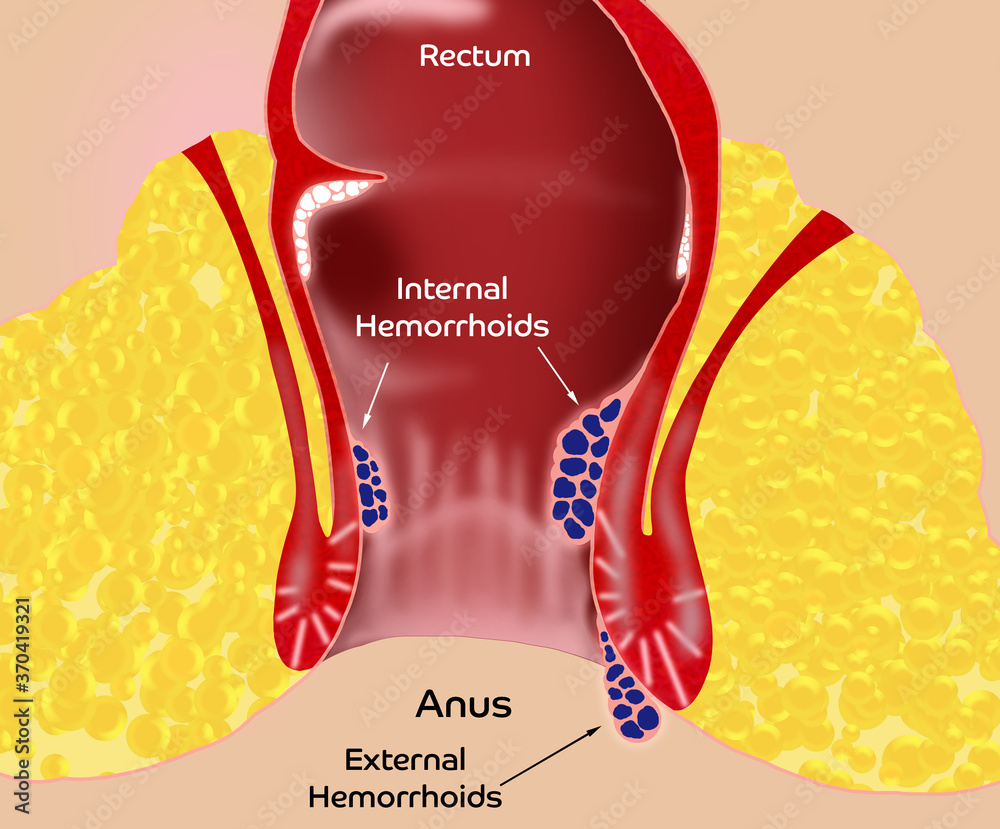 Hemorrhoid. Illustration of unhealthy lower rectum with inflamed